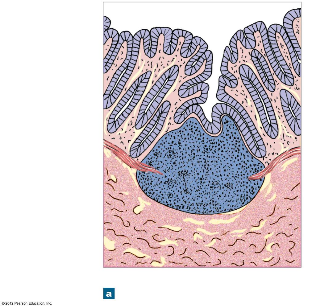 Figure 22-7a Lymphoid Nodules (Part 2 of 2) Intestinal lumen Mucous membrane Germinal center
