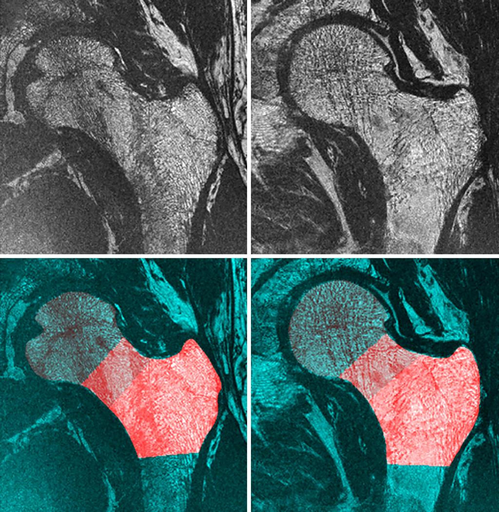 Quantitative Imaging in Medicine and Surgery, Vol 8, No 1 February 2018 7 A B C D Figure 1 Representative coronal cross-sections of high-resolution magnetic resonance images of the proximal femur of