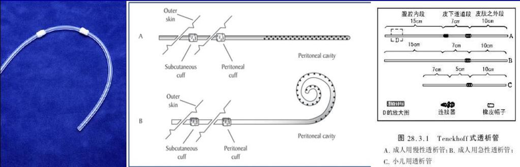 PD catheter implantation (double-cuff