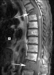 Bone Spinal Cord