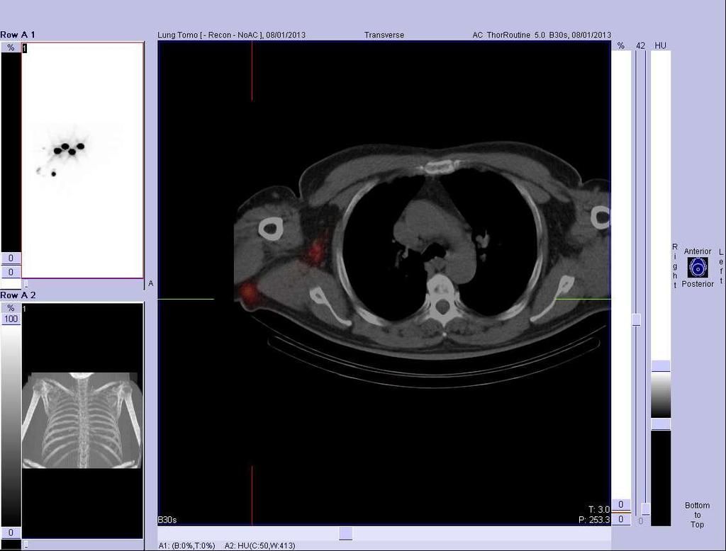 SPECT/CT in a patient with CMM on the back -