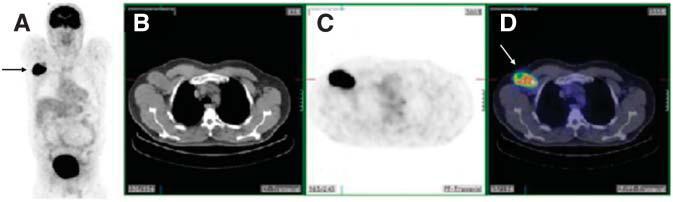 Application the hybrid imaging method PET/CT 1. Staging PET/CT has no role in the diagnosis and local tumor spread (T stage).