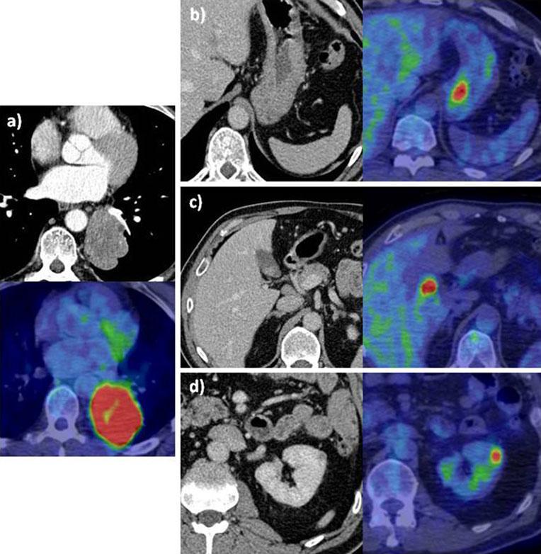 Restaging with PET/CT in a patient