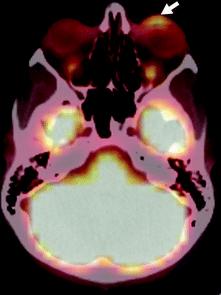 PET/CT of a patient with MCC in the