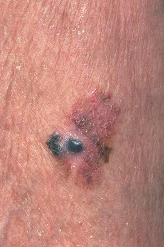 situ T1:Melanoma 1.0 mm in thickness T1a: Without ulceration and mitoses < 1/mm 2 T1b: With ulceration or mitoses 1/mm 2 T2: Melanomas 1.01-2.