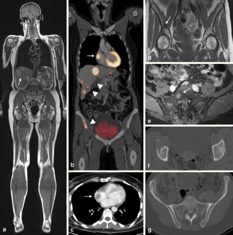 Choice of imaging modality for staging of CMM Currently, whole body MRI with diffusion weighted imaging /WB-MRI with DWI/, is established as one of the most promising modern functional imaging