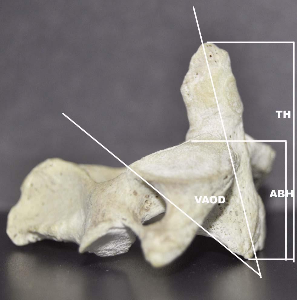 Morphometric study of the Axis vertebra tion is clearly indicated (Doherty and Heggeness, 1995).