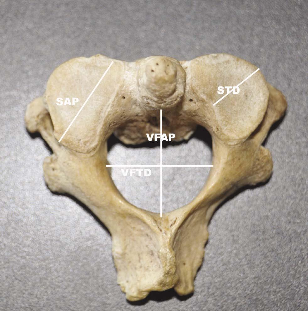 point of the superior articular facet to the lower-most point on its inferior surface.