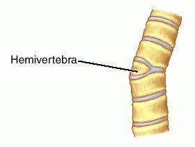 Feature: defective vertebrae produce scoliosis (lateral curvature).