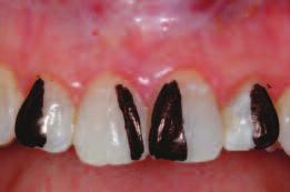 After initial consultation, he was advised to seek an orthodontic consultation to help meet his esthetic objectives.