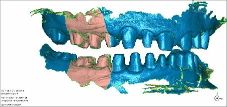 Scanning Challenge-Articulation Solution was to scan the interocclusal record vertically.