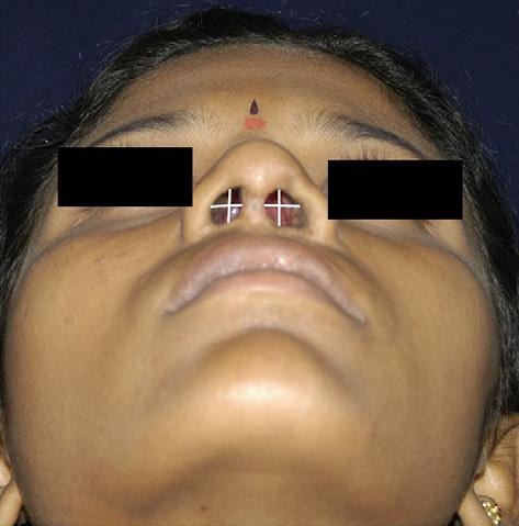 S. Gosla Reddy et al. / Journal of Cranio-Maxillo-Facial Surgery 41 (2013) 147e152 149 Fig. 3. Dorsal onlay grafting e diagrammatic illustration. Measurement of nostril width and height. Fig. 4. Strut grafting e diagrammatic illustration.