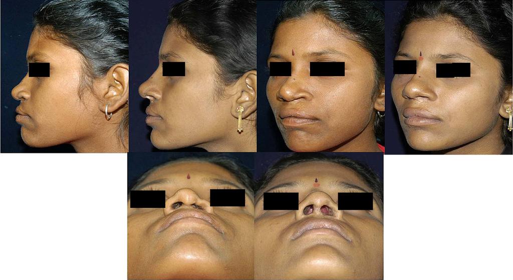 150 S. Gosla Reddy et al. / Journal of Cranio-Maxillo-Facial Surgery 41 (2013) 147e152 Fig. 6. Strut grafting e preoperative and postoperative photographs.
