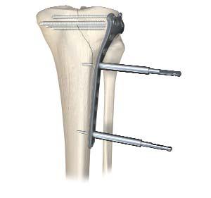 Screw Insertion Proceed with definitive fixation of fracture using appropriate screw selections.
