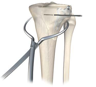 4.5mm Lateral Proximal Tibia Locking Plate Articular Reduction and Provisional Fixation It is important that articular fracture reduction be obtained prior to placement of locking screws.
