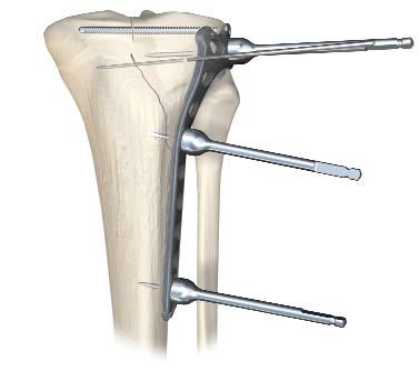 Plate Positioning Insert the plate and position it to the lateral proximal tibia. Reduce the fracture manually and confirm coronal and sagittal alignment as well as plate position on the shaft.