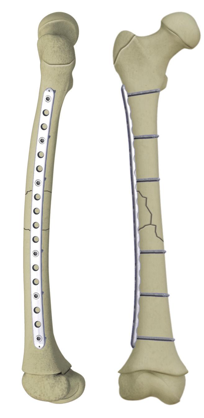 Pre-Operative Planning Determine whether a 3.5mm or 4.5mm plate will be necessary depending on the age of the patient and size of the femur.