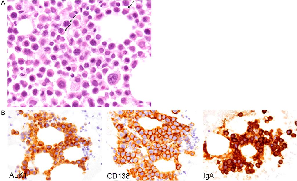 Figure 2. Histopathological and immunohistochemical features of the bone marrow aspiration.