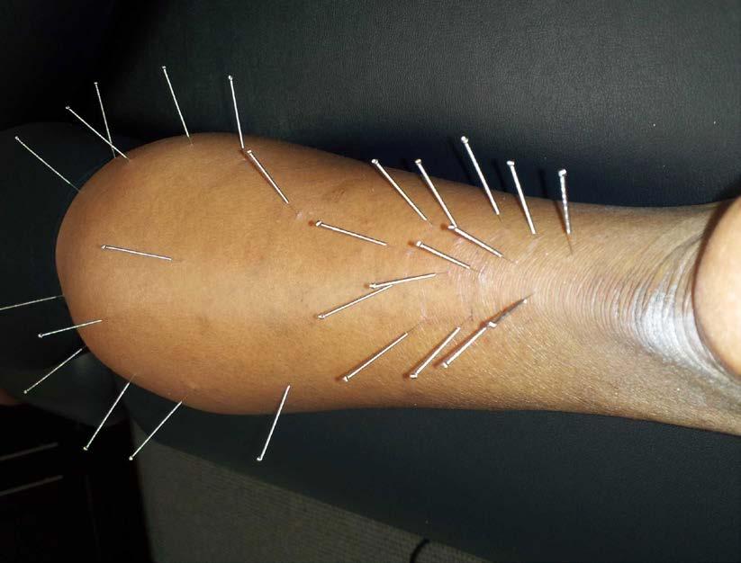 Dry Needling Immediate increase local RBC saturation & oxygenation by red light laser Systematic lit review: 20% Achilles improve 50% tennis elbow