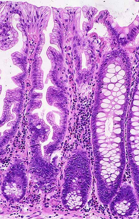 What is serrated pathology?