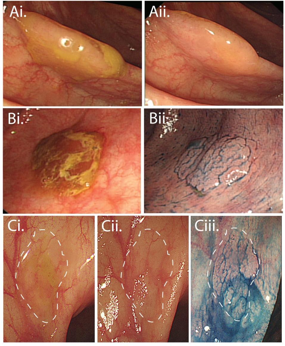Endoscopic appearances of SSLs difficult to spot at endoscopy predilection for right side