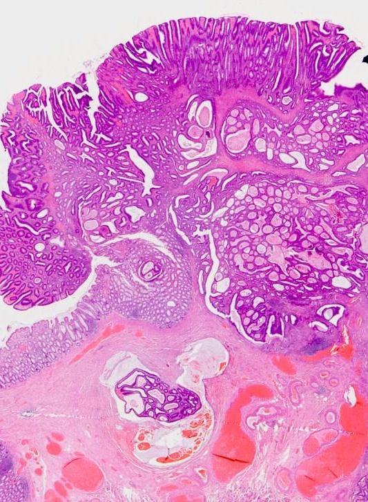 Epithelial misplacement in adenomas 85% in sigmoid colon unusual in rectum (unless there has been previous intervention) same epithelium as surface,