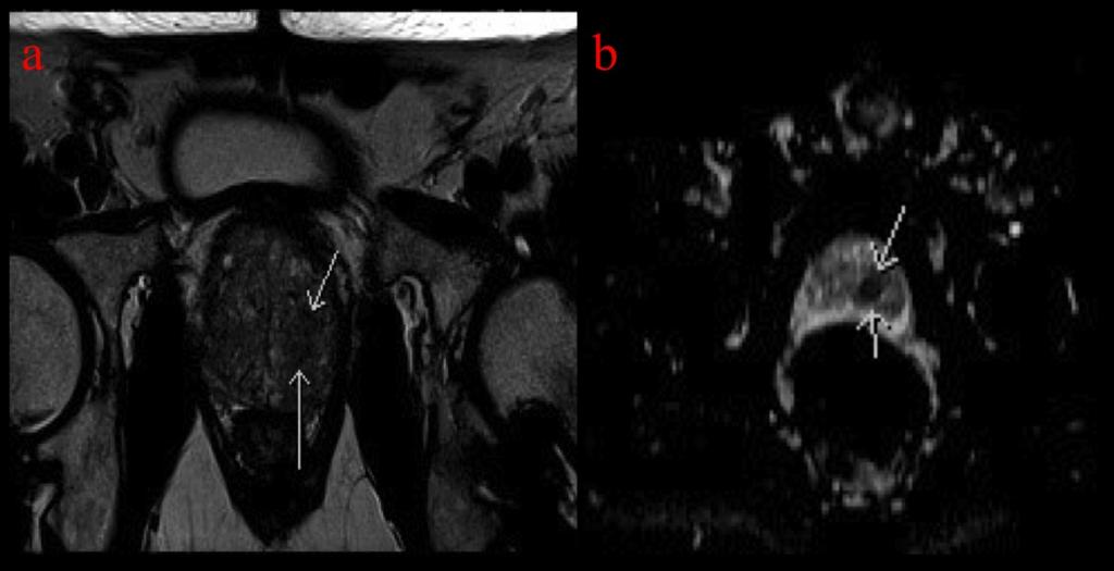 Fig. 7: Axial T2 (a) and axial ADC map (b) of the prostate demonstrating T2 signal abnormality with correlating diffusion