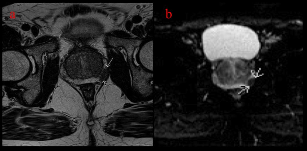 Fig. 3: Axial T2 (a) and axial ADC map (b) of the prostate demonstrating a T2 signal