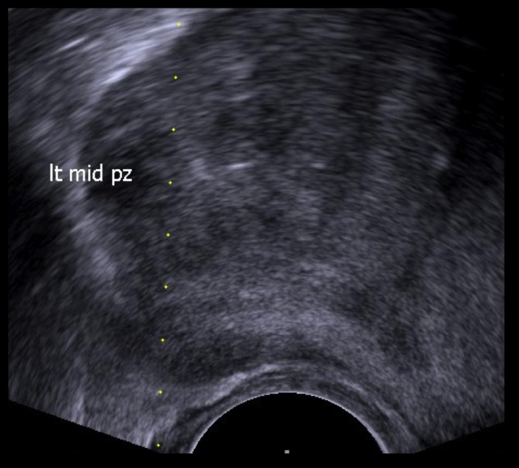Fig. 4: Transrectal ultrasound of prostate demonstrating a hypoechoic lesion in the left mid peripheral zone corresponding to MRI findings. Case 4: A 69 year-old male presented with PSA 13 µg/l.