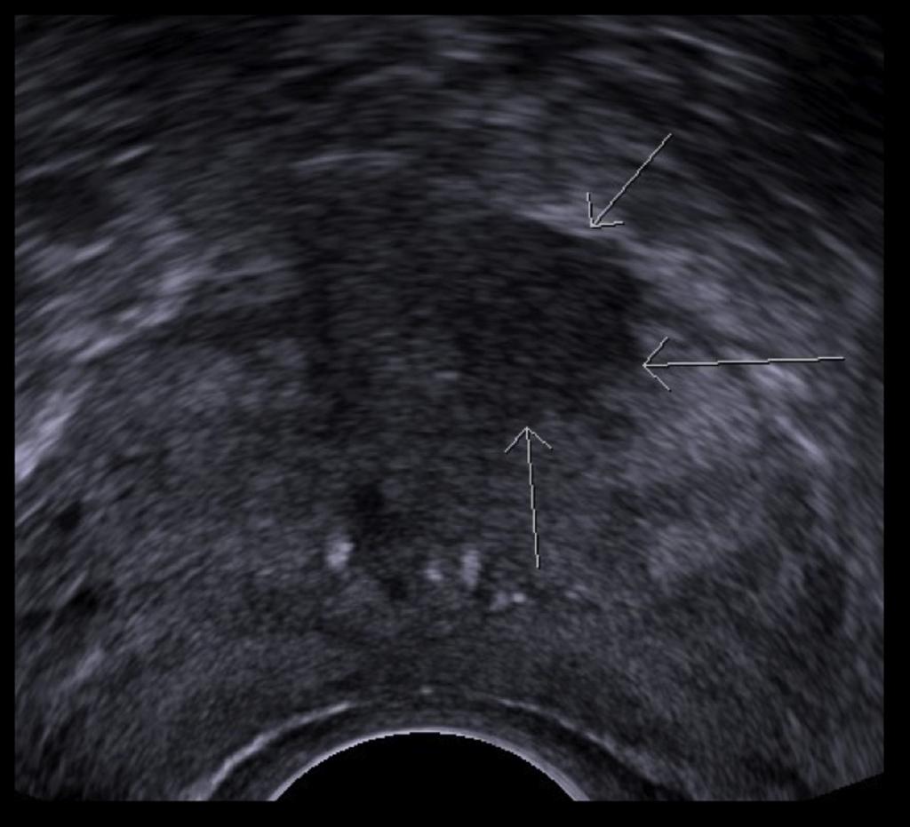 Fig. 6: Transrectal ultrasound of prostate demonstrating a hypoechoic lesion in the right mid gland anteriorly corresponding to MRI findings. Case 5: A 60 year-old male presents with PSA 36 µg/l.