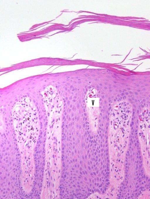 Figure 3: high power microscopic view shows edema and dilated tortuous blood vessels(v) in papillary dermis.