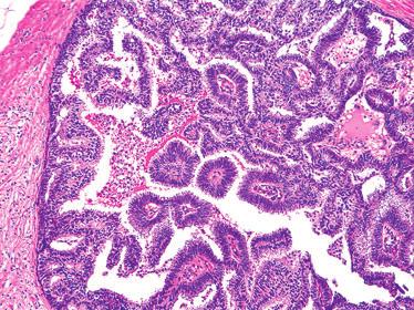In addition to the neoplastic columnar epithelial cells covering the papillae, a second population of cells with pale cytoplasm is evident,