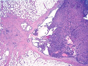 28 L C Collins & S J Schnitt A B Figure 14. Epithelial displacement after core needle biopsy of an intraductal papilloma.