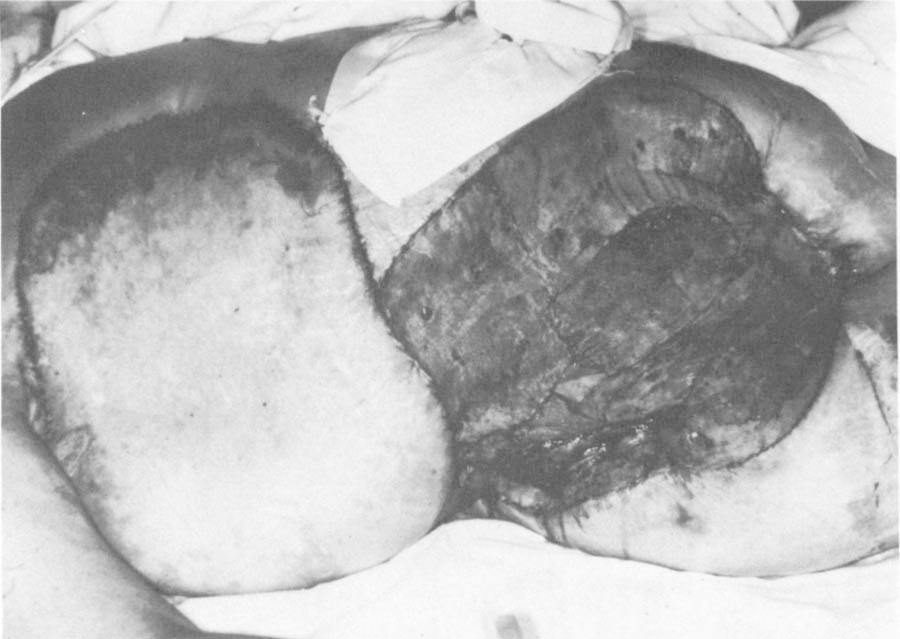204 The Annals of Thoracic Surgery Vol 32 No 2 August 1981 Fig 2. This patient underwent resection of a large portion of the right anterior chest for sarcoma.