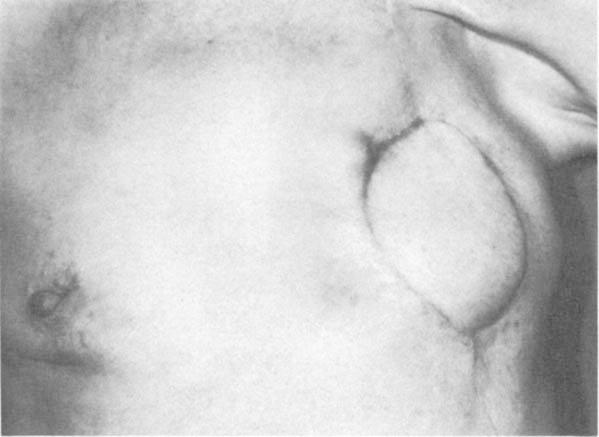206 The Annals of Thoracic Surgery Vol 32 No 2 August 1981 A B Fig 5. (A) The arc of rotation and area that can be covered by the latissimus dorsi myocutaneousflap.