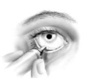 Remove the cap from the tube. Using your forefinger, gently pull your lower eyelid down to form a pouch (see Diagram 1). Diagram 1 3.