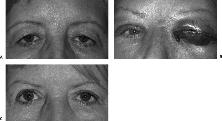 MANAGEMENT OF COSMETIC EYELID SURGERY COMPLICATIONS/KLAPPER, PATRINELY 83 Figure 1 (A) A 60-year-old woman with upper eyelid ptosis and dermatochalasis.