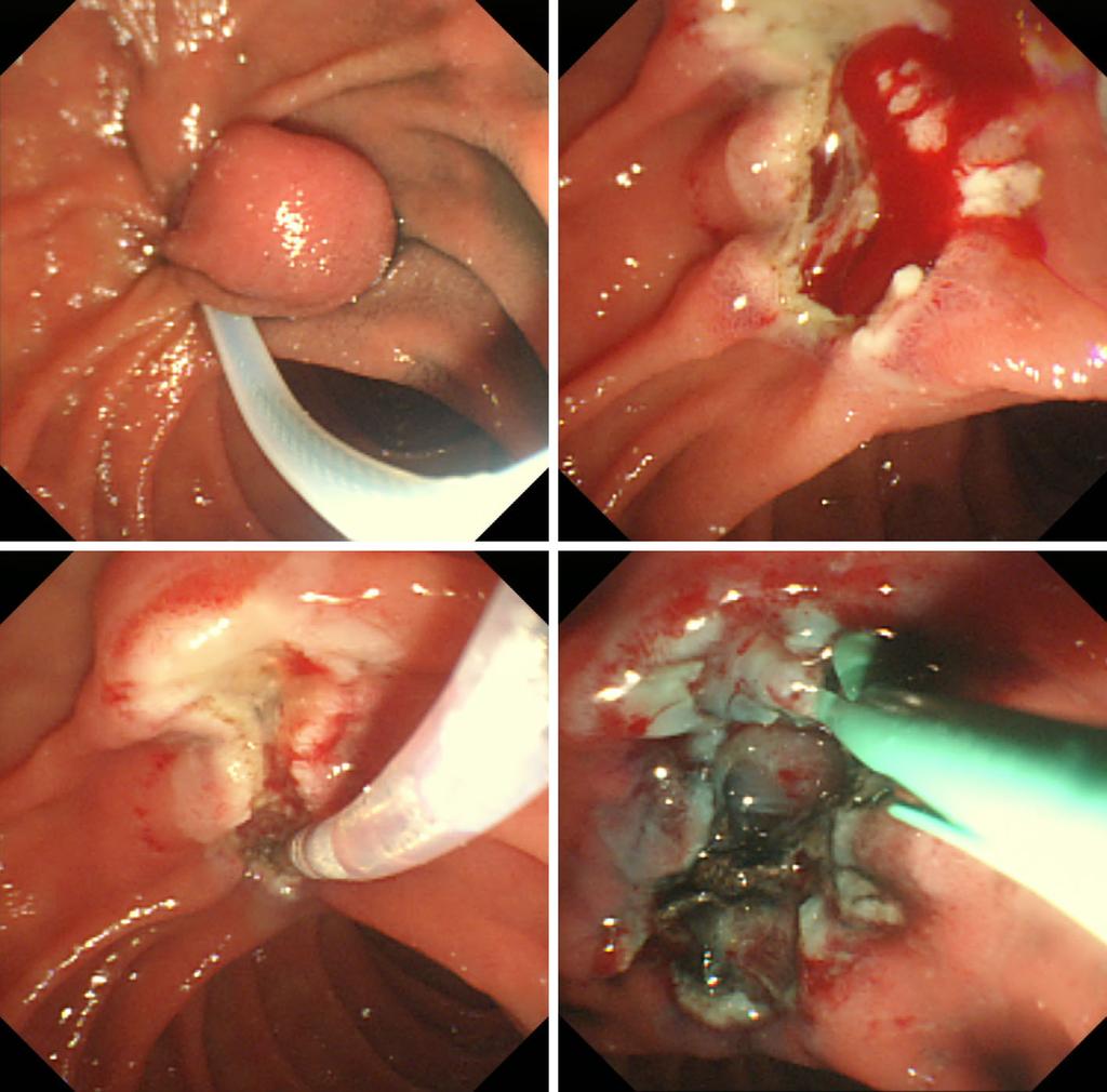a b c d Figure 7. Endoscopic papillectomy for G1 NET of the ampulla of Vater. (a) Endoscopic snare papillectomy. (b) Immediate bleeding after papillectomy.
