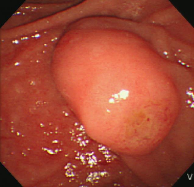 Case Report 2 Ampullary neuroendocrine tumor diagnosed by endoscopic papillectomy in previously confirmed ampullary adenoma Authors: Tae Hoon Lee 1, Si-Hyong Jang 2 Affiliation: Division of