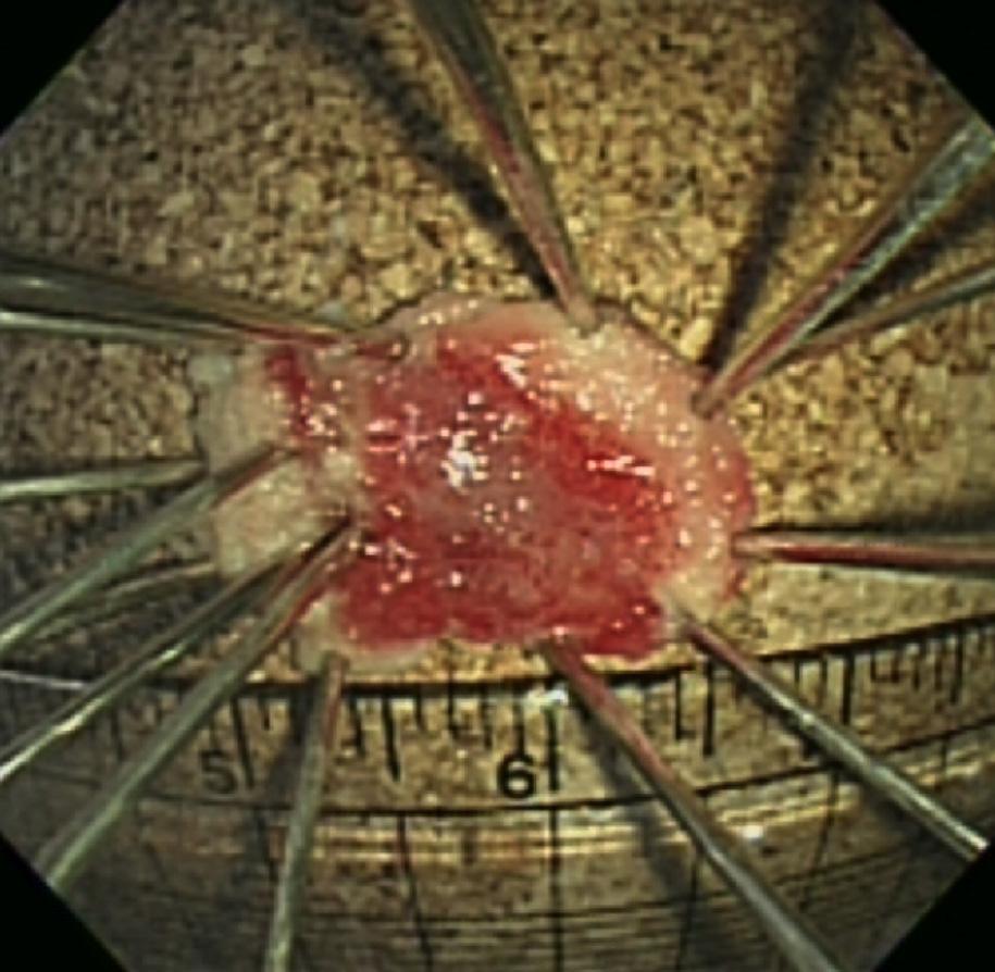 tumor. Therefore, a second resection was performed successfully in the same manner as the first one.