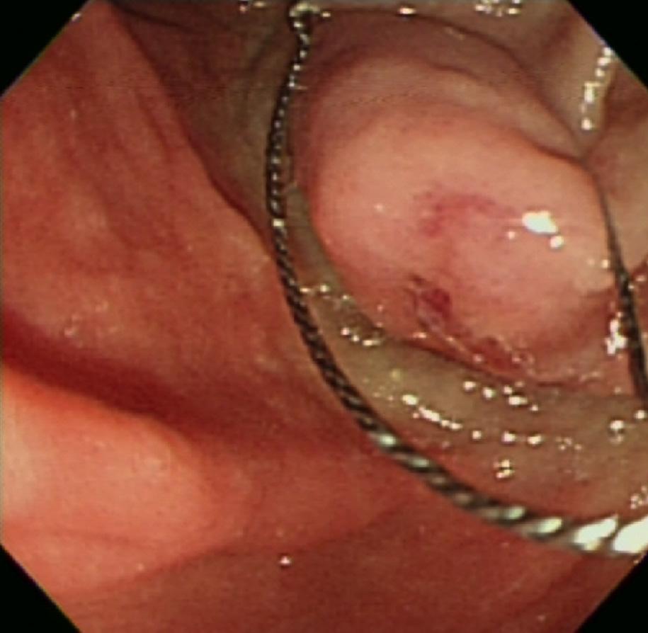 Resected tissues showed a papillary roof lesion and a whitish, round, mass-like lesion (Fig. 2).