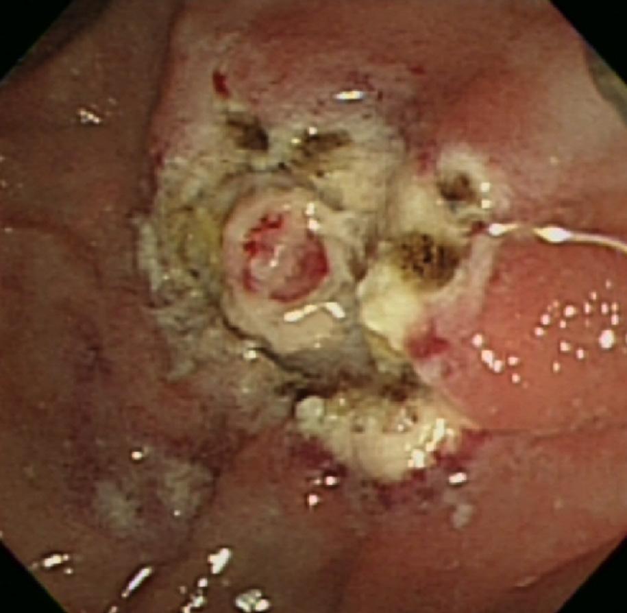 The protruding lesion was composed of two lesions that differed in their histological characteristics: tubular adenoma and neuroendocrine tumor (NET).
