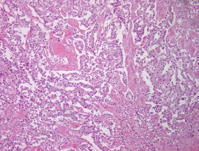 A C D Figure 3 (A) The protruding whitish mass lesion is composed of two lesions that differed in their histological characteristics: