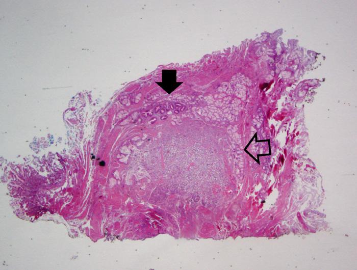 () The tubular adenoma lesion exhibit round-to-oval enlarged glands with stratified epithelial cells. (H-E, 100).