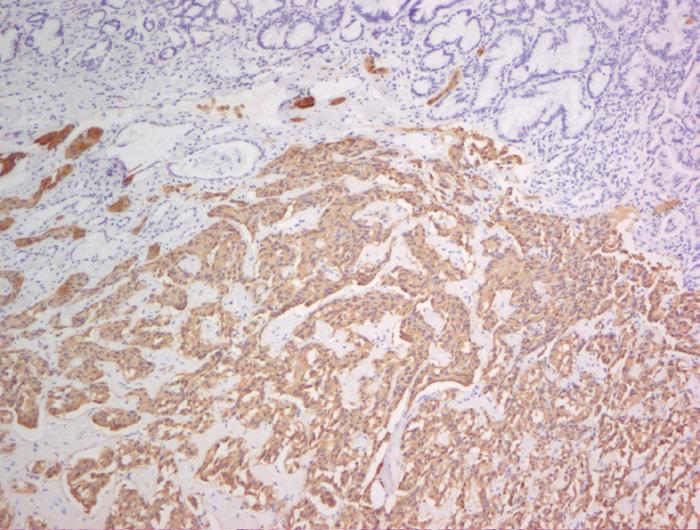(D) Immunohistochemistry show that the tumor cells were positive for synaptophysin ( 100).