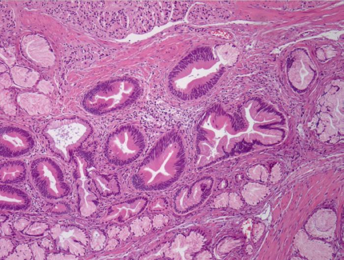 DISCUSSION NET of the ampulla of Vater, formerly known as carcinoid tumors, is extremely rare. It accounts for only 0.