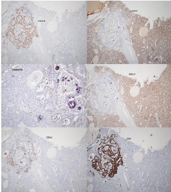 FIGURE 2. Immunohistochemical staining showing an oncocytoma positive for E-cadherin and CD117, but negative for CK7, CD10, and AMACR. The reverse was found in the papillary carcinoma.