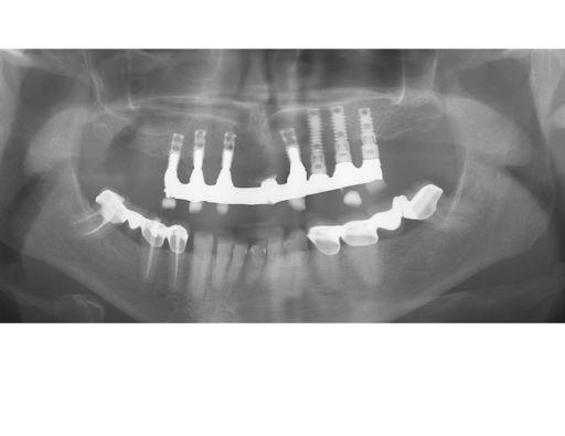 Pretreatment radiographs with failing