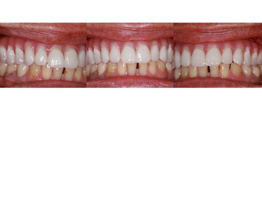 TEETH IN A DAY provisional prosthesis