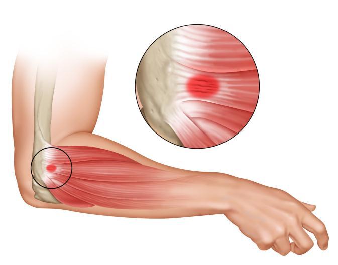lateral epicondyle of the humerous. The typical symptoms include lateral elbow pain, pain with wrist extension, and weakened grip strength.